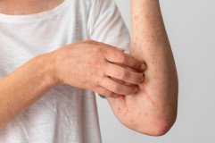 skin-allergy-reaction-person-s-arm_23-2149140472